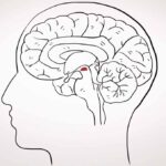 Parkinson's disease