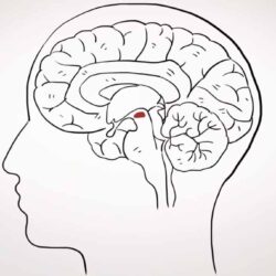 Parkinson's disease