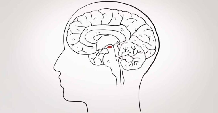 Parkinson's disease