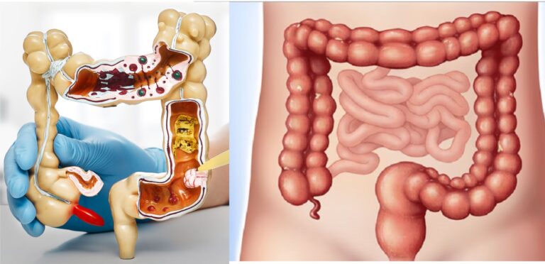 Colon Irrigation Basti kriya