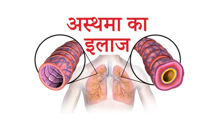 अस्थमा